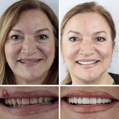 🌎Ends Today: 70% OFF! ⏰LUMIVO® Medical Full Denture with Strong Suctiond🦷Obtain American Dental Association (ADA) Certification